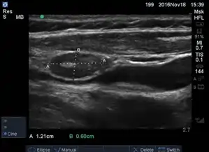 lymph9